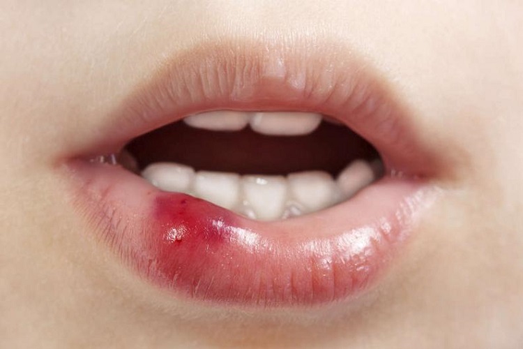 Dấu hiệu phun môi bị hỏng Nguyên nhân cách khắc phục